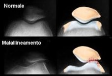 lateralizzazione rotula