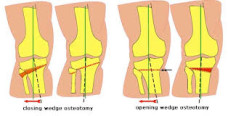 ginocchio valgo osteotomia