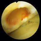 lesione cartilagine