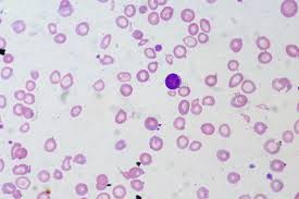 visione al microscopio di sangue anemico