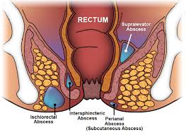 ascesso anale