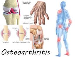 osteoartrite