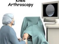 L’artroscopia di ginocchio: cosa c’è da sapere